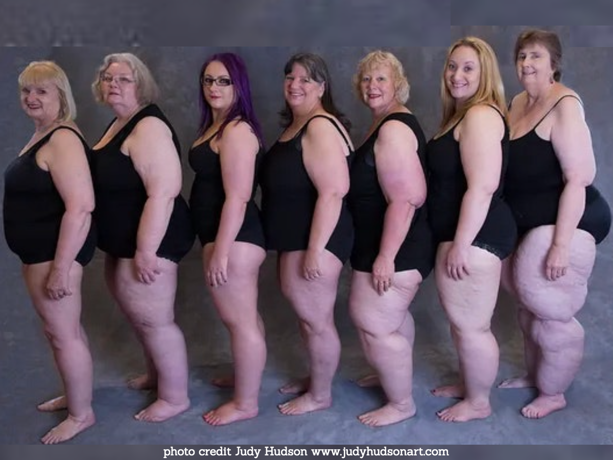 ladies with lipoedema in their bathing costumes smiling. They have varying stages and types of Lipoedema affecting arms and legs